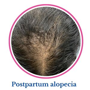 Postpartum Alopecia
